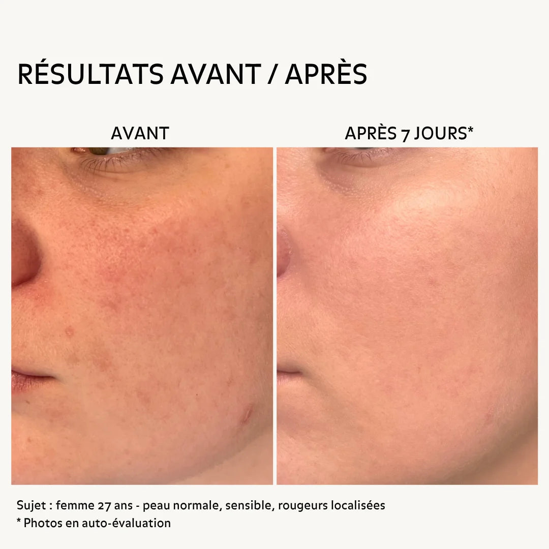 Résultats avant après soins Puréality : réduction des rougeurs et peau plus uniforme après 7 jours sur peau sensible