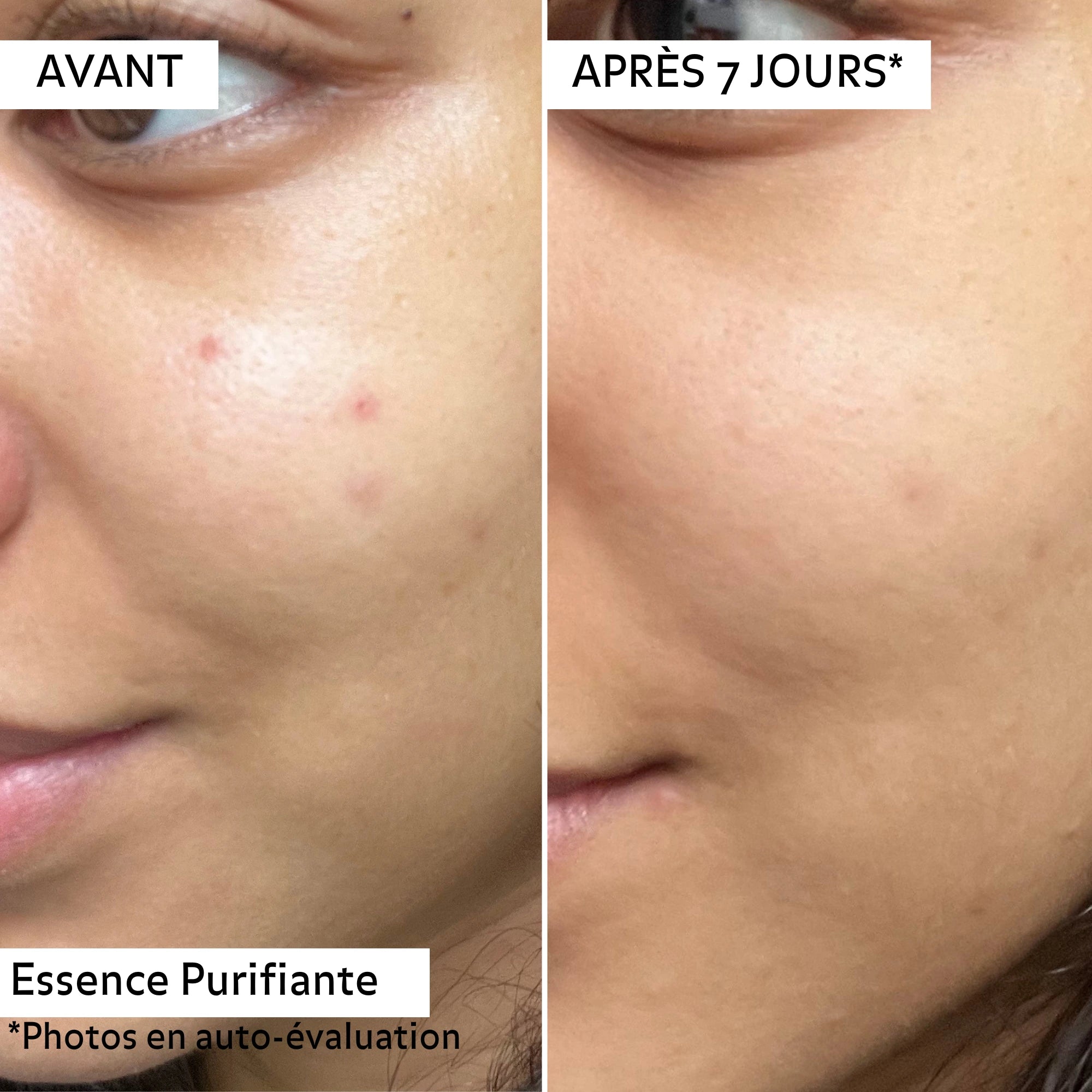 Avant/après 7 jours avec l’essence purifiante Pureality : réduction visible des imperfections, peau plus nette et lissée.