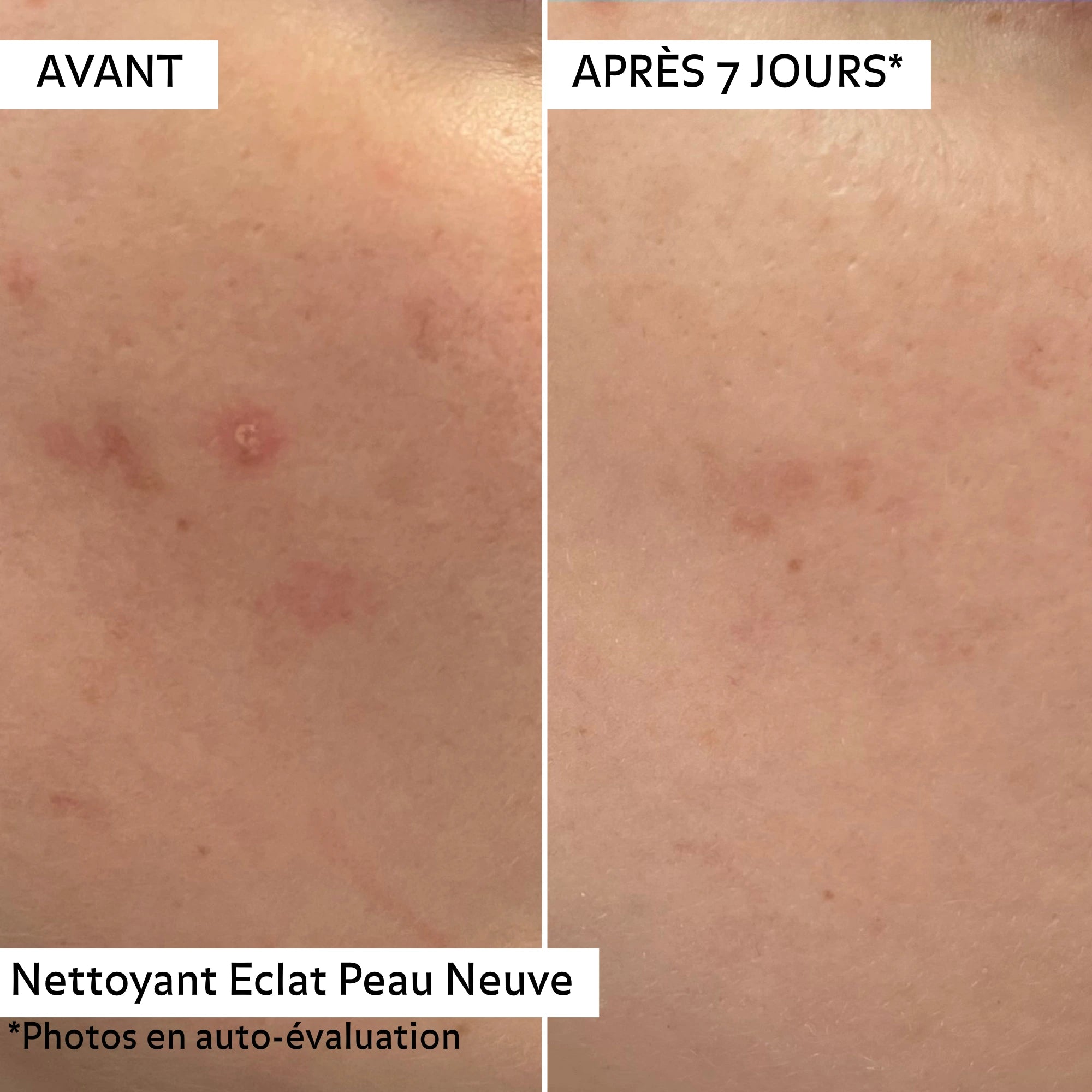 Avant/après 7 jours avec le Nettoyant Éclat Peau Neuve Puréality : peau visiblement purifiée, plus lisse et grain de peau affiné.