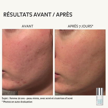 Photos avant après 7 jours d’utilisation du sérum matifiant anti-imperfections Puréality sur peau mixte à tendance acnéique
