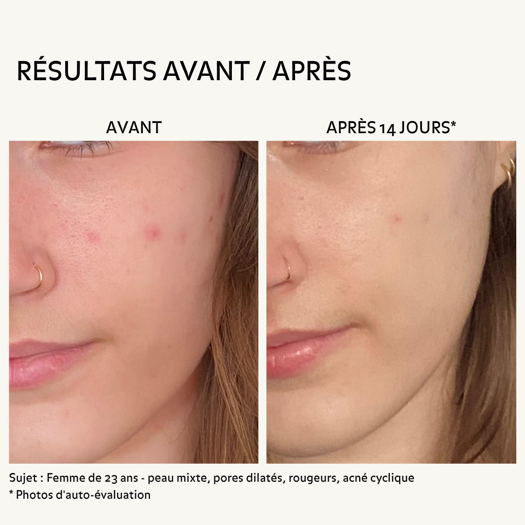 Résultats avant après soin visage Puréality : amélioration des rougeurs et imperfections après 14 jours sur peau mixte à tendance acnéique