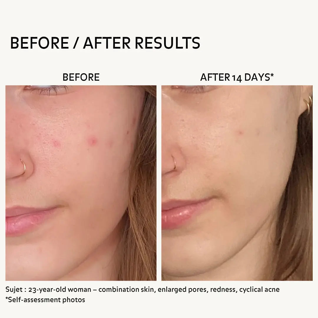 Before and after skincare results showing reduced acne, redness and smoother skin after 14 days using Puréality routine