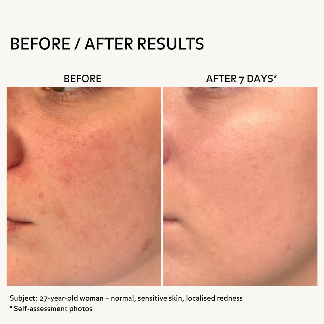 Before and after skincare results showing reduced redness and more even skin tone after 7 days on sensitive skin