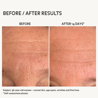 Before and after forehead wrinkles on 56 year old woman after 14 days using radiance skincare routine showing smoother skin reduced fine lines improved skin texture more even tone and visible reduction of age spots