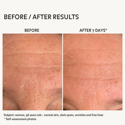 Before after forehead wrinkles on 56 year old woman after 7 days using hydrating anti aging skincare showing smoother skin reduced fine lines improved texture and more even tone