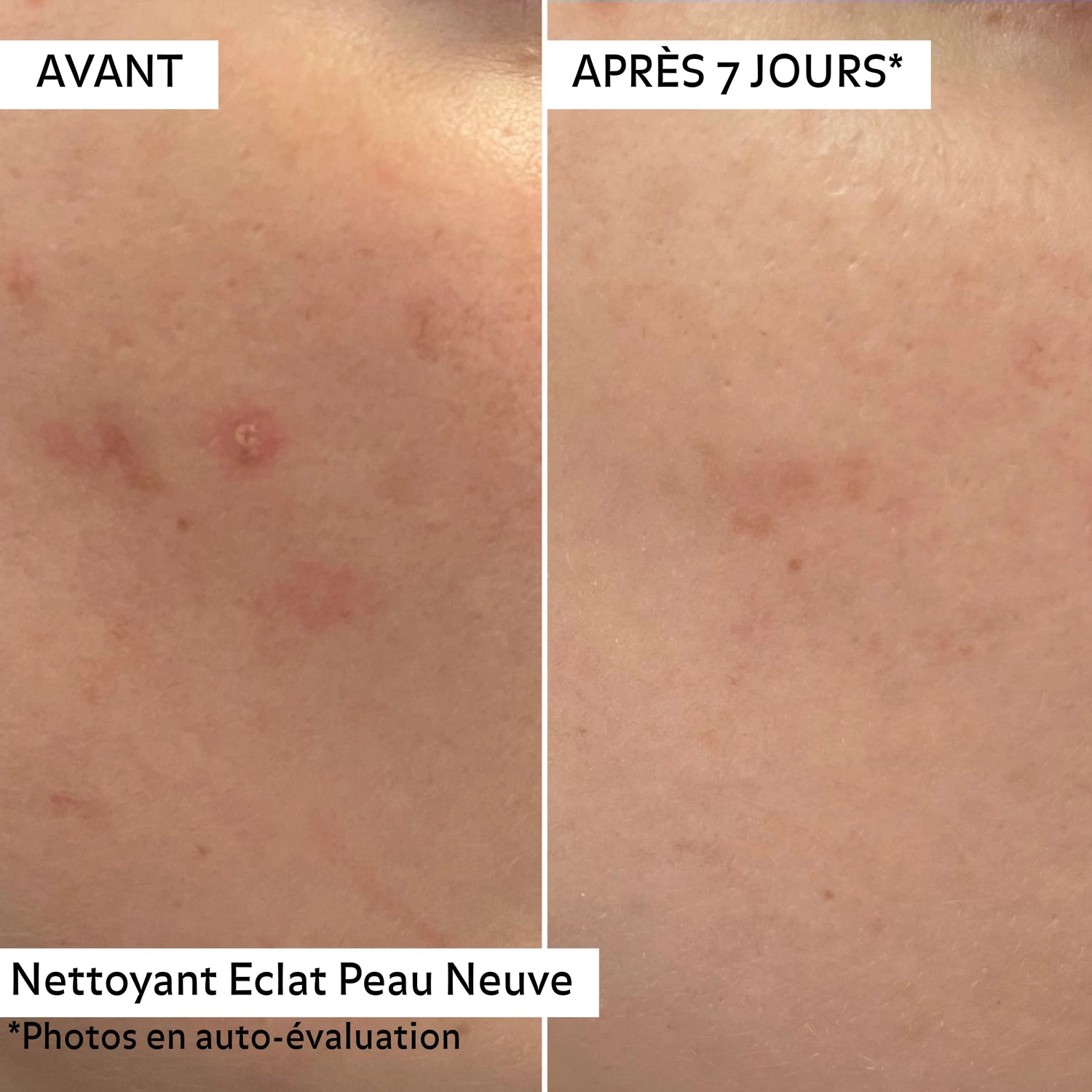 Avant/après 7 jours avec le Nettoyant Éclat Peau Neuve Puréality : peau visiblement purifiée, plus lisse et grain de peau affiné.