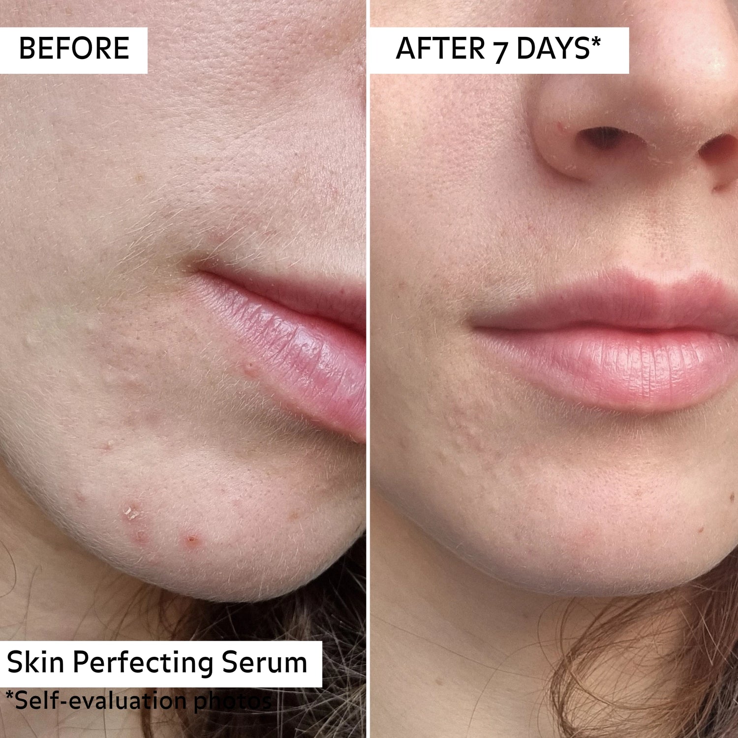 Avant/Après 7 jours application du serum perfecteur.
Réduction d&