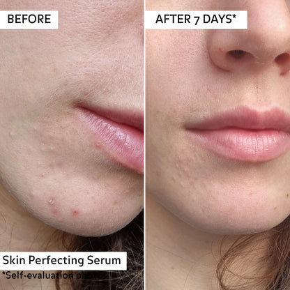Avant/Après 7 jours application du serum perfecteur.
Réduction d&